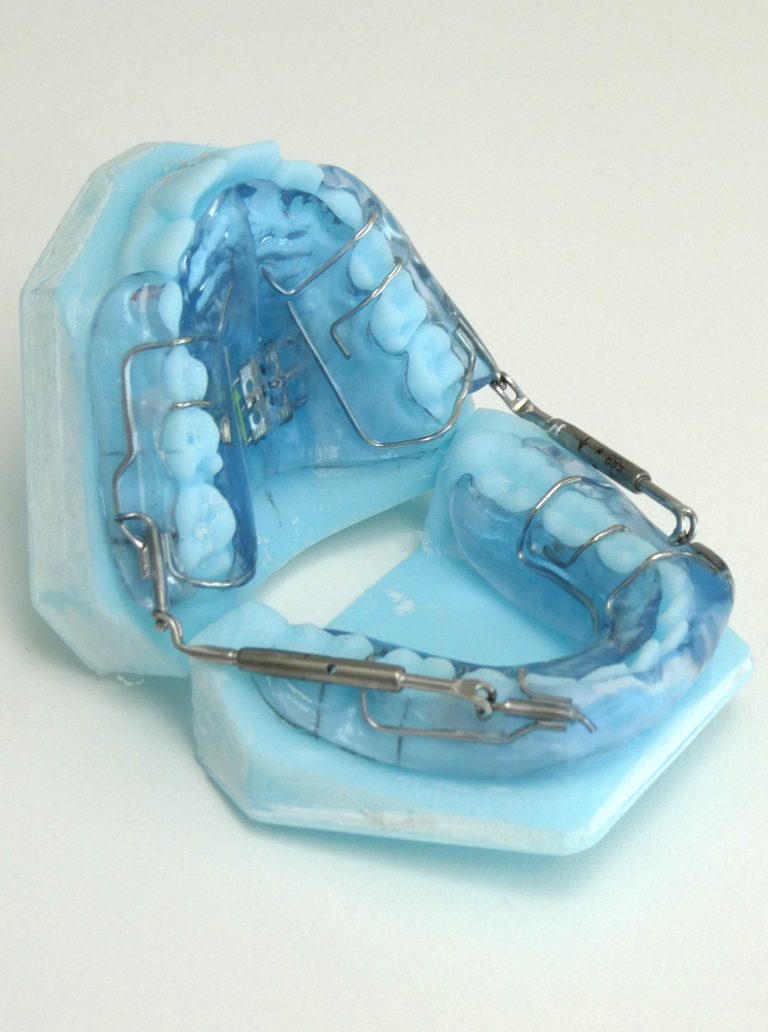 illustration arc blessant Appareil orthodontique dentaire sur modèle, avec fils métalliques et aligneurs en plastique, présenté sous un angle aérien.