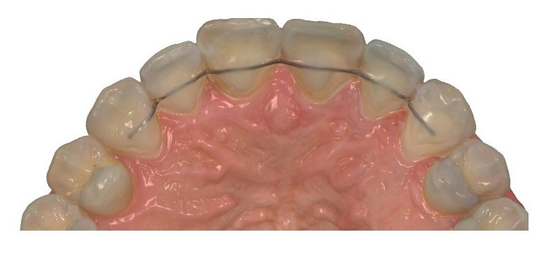 illustration urgences Un modèle en plâtre de dents humaines montrant un appareil orthodontique avec des fils de contention sur les dents du haut. Les gencives sont représentées en rose, et les dents sont blanches.